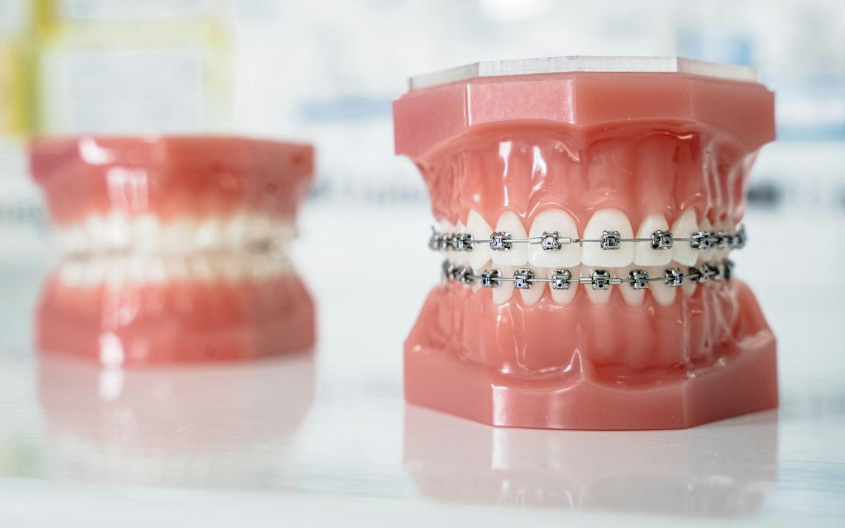 Braket ve tel takılı diş modeli