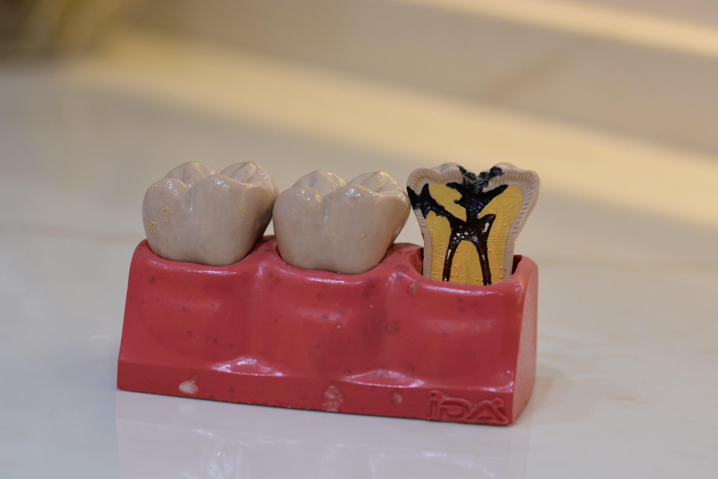 Diş çürüğünü gösteren eğitim modeli