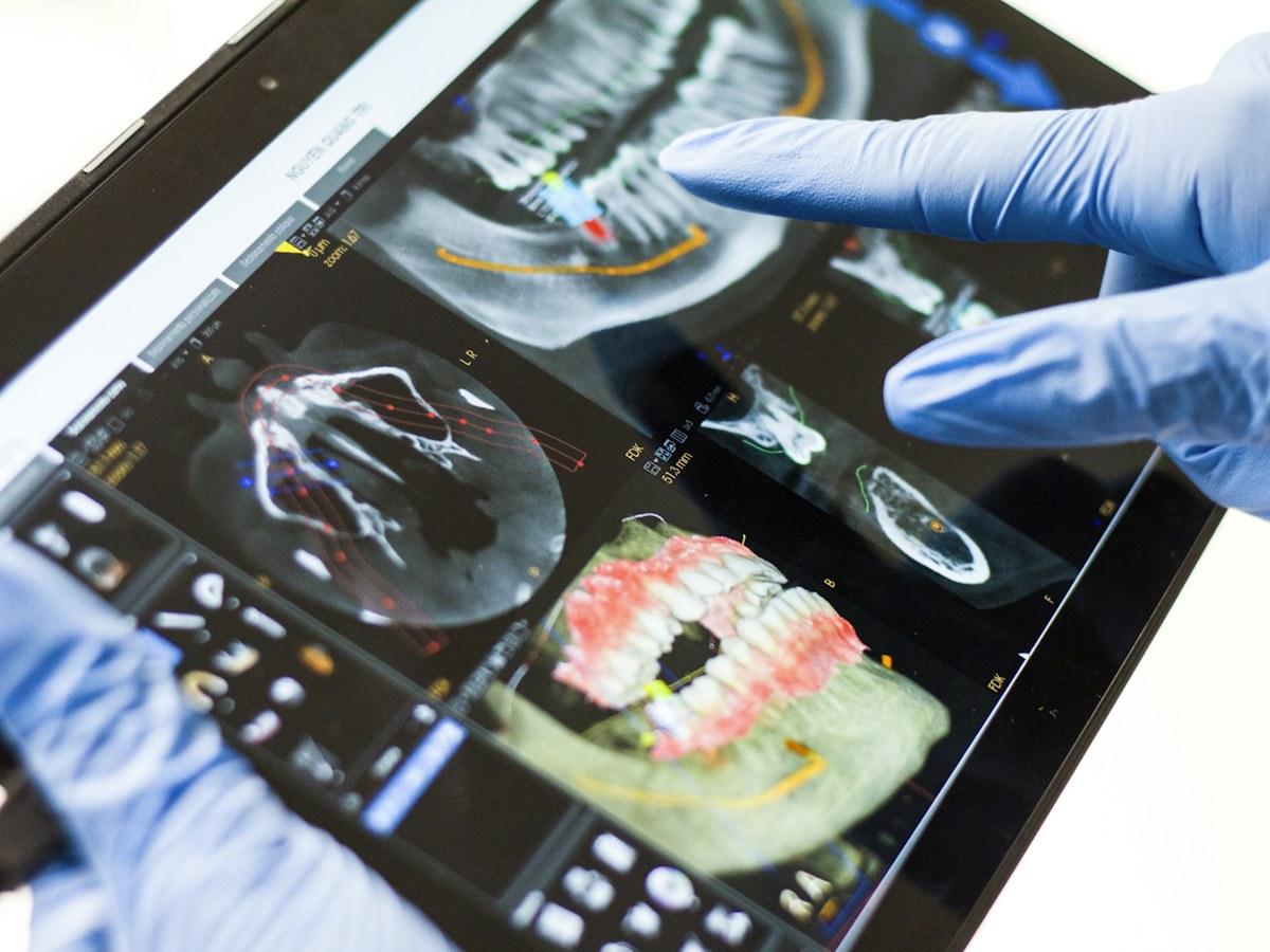 Cerrahi rehberle implant uygulamasını temsil eden görsel