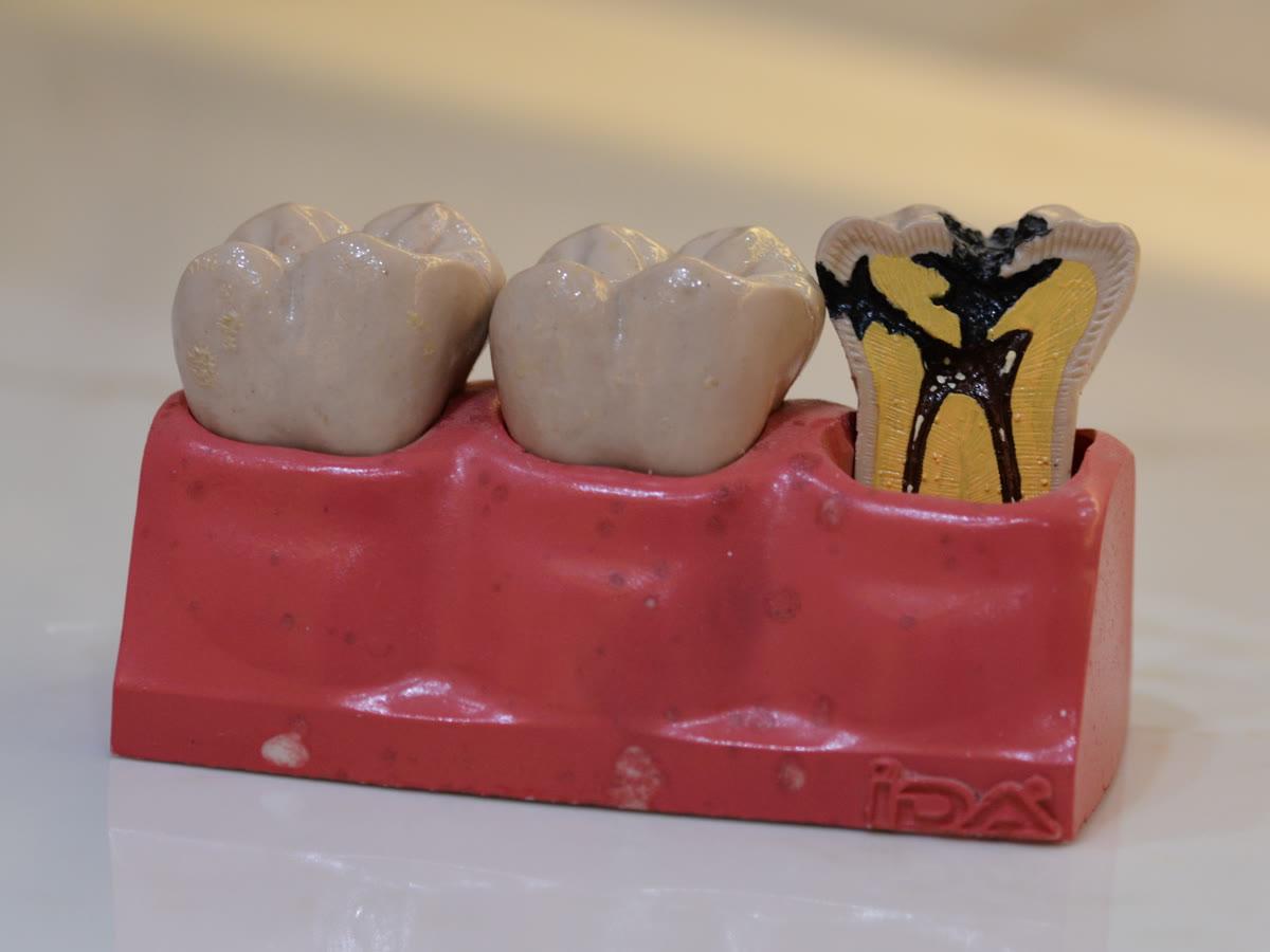 Diş çürüğünü gösteren eğitim modeli