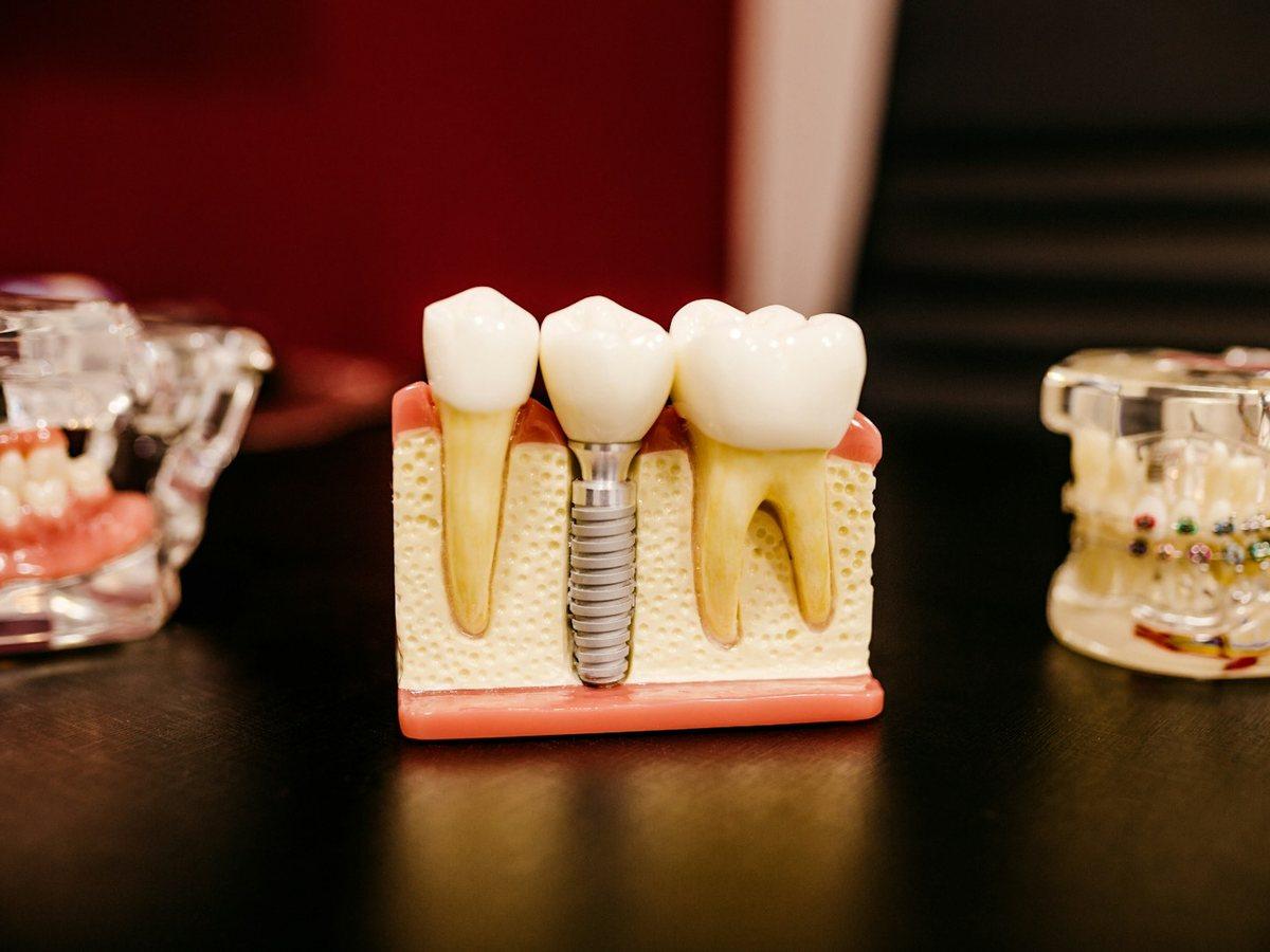 Diş implantı uygulamasını temsil eden görsel