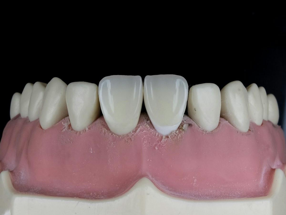 Model üzerinde ön diş kaplamaları